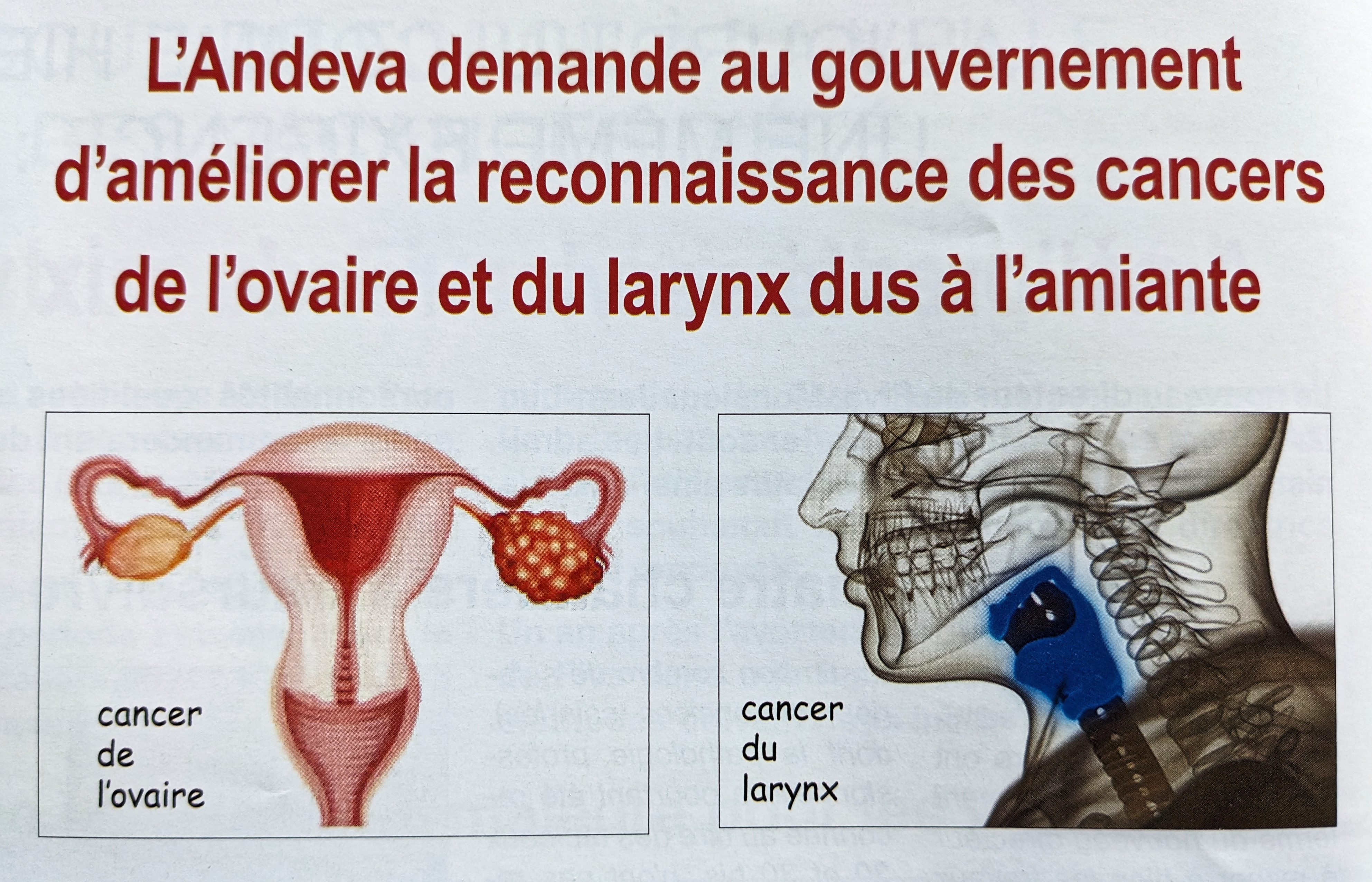 Les cancers du larynx et de l'ovaire provoqués par l'amiante reconnus en  maladie professionnelle - Le Parisien